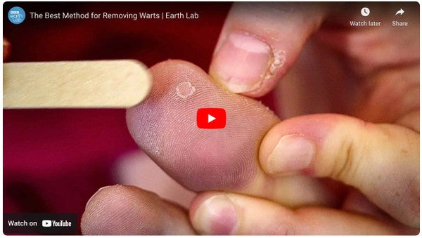 The best way to remove a wart